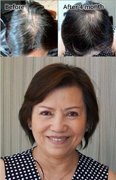 female hair loss melbourne