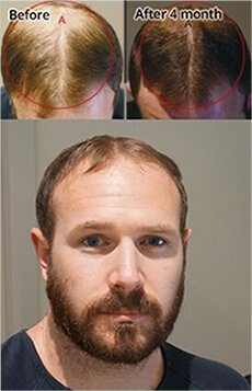 male hair loss melbourne