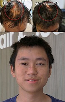 male hair loss